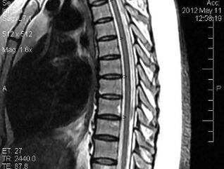 MRI of the thoracic spine