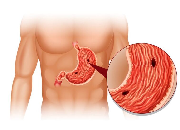 ulcer as the cause of pain under the left scapula behind