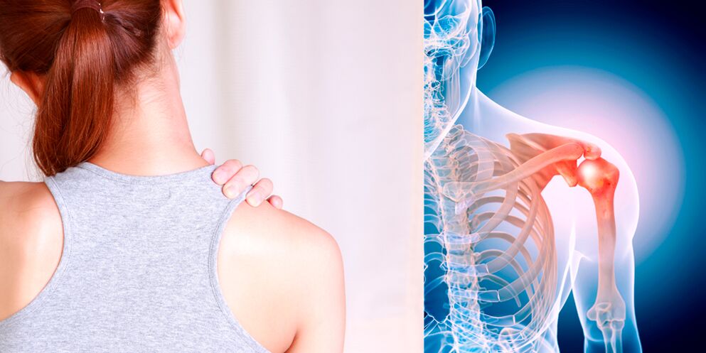 The development of osteoarthritis of the shoulder gradually leads to constant pain