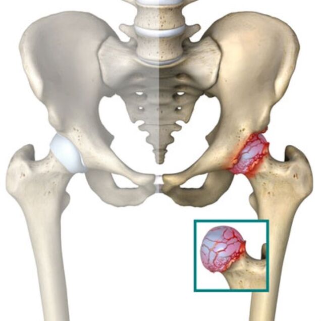 arthrosis of the hip joint