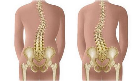Non -resistant scoliosis