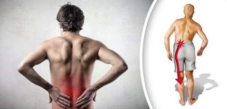 Pain syndrome with lumbar osteochondrosis radiates to the legs