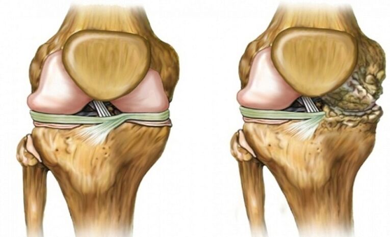 Healthy and affected by arthrosis joint