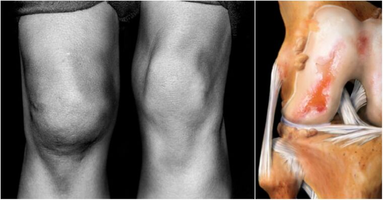 arthrosis of the knee joint and sore joint