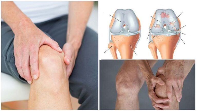 knee pain symptom of arthrosis of the knee joint