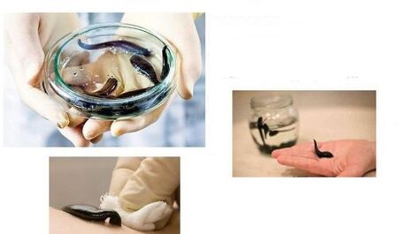 hirudotherapy for arthrosis