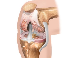 scheme of osteoarthritis